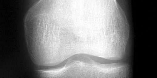 knee-x-ray-1-1562064.jpg